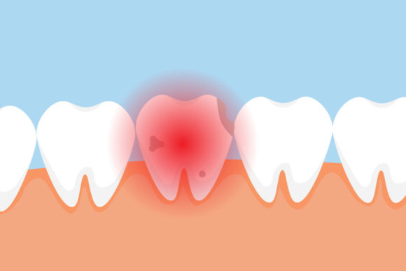 Understanding and Utilizing the Dead Tooth with Cavities Hurting Vector